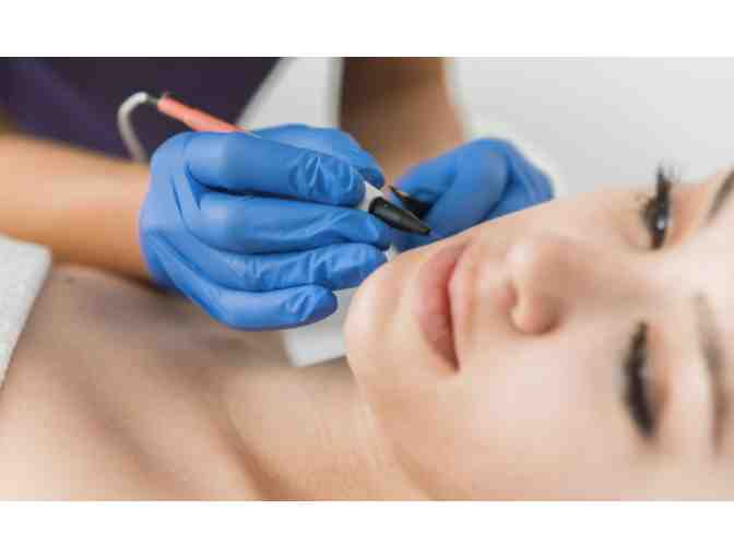 Fifteen Minute Electrolysis Session